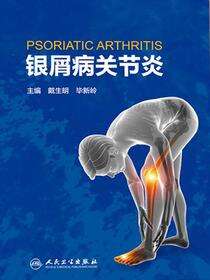 银屑病关节炎